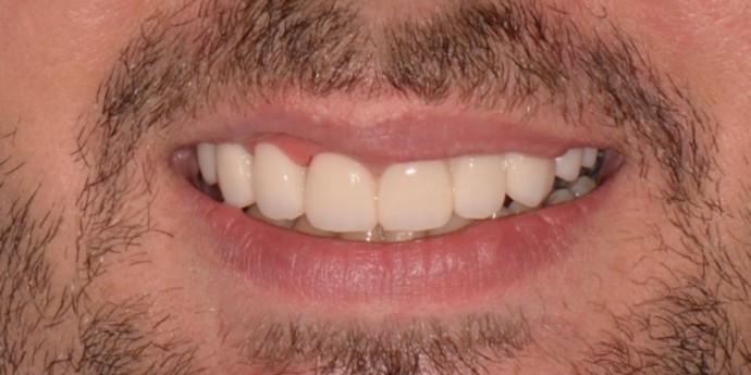 Zubné mostiky farba A1