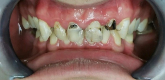 Zubné mostiky - zircon