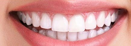 Profesionálne bielenie zubov Power Whitening
