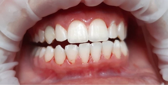 Profesionálne bielenie zubov Power Whitening
